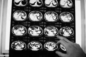 MRI आणि CT scan यादोघांमध्ये कोणता फरक आहे?
